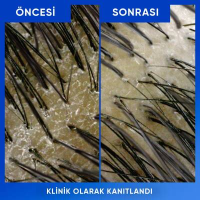Hs Arındırma&Parlaklık Kepeğe Karşı Etkili Şampuan 330 Ml - 5